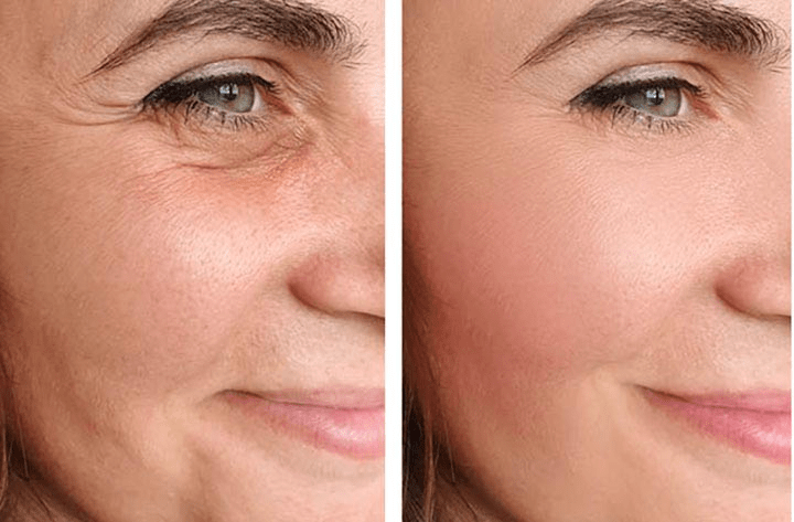 before and after non surgical facelift results