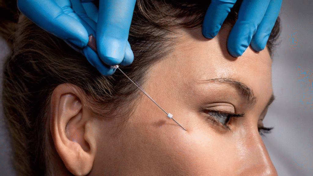 thread lift facelift procedure with dissolvable sutures